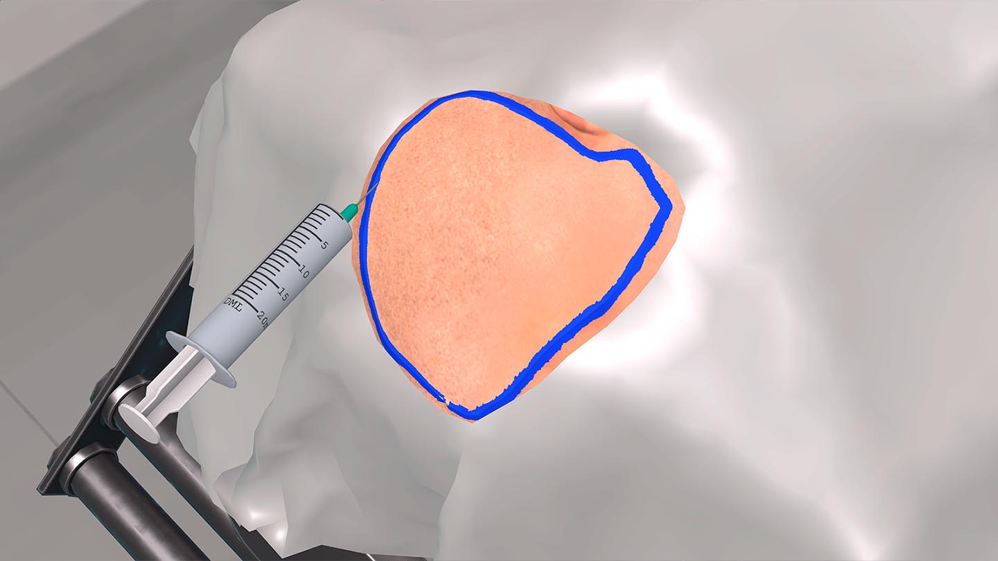 Образовательный комплекс «Виртуальная хирургическая операционная: Декомпрессионная краниотомия»
