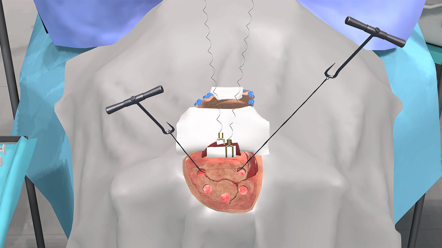 Образовательный комплекс «Виртуальная хирургическая операционная: Декомпрессионная краниотомия»